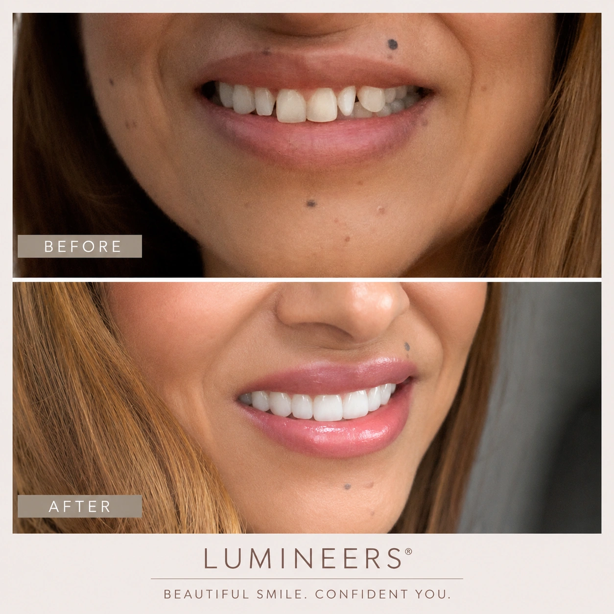 Before and after Lumineers in La Jolla and Chula Vista