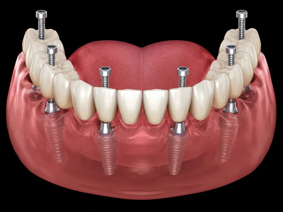 All-on-6 dental implants supporting a full arch of fixed replacement teeth