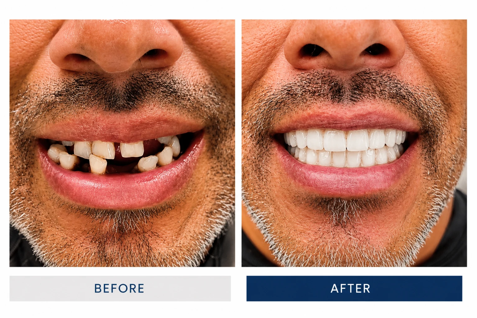 Before and after All-on-6 dental implant treatment showing full smile restoration
