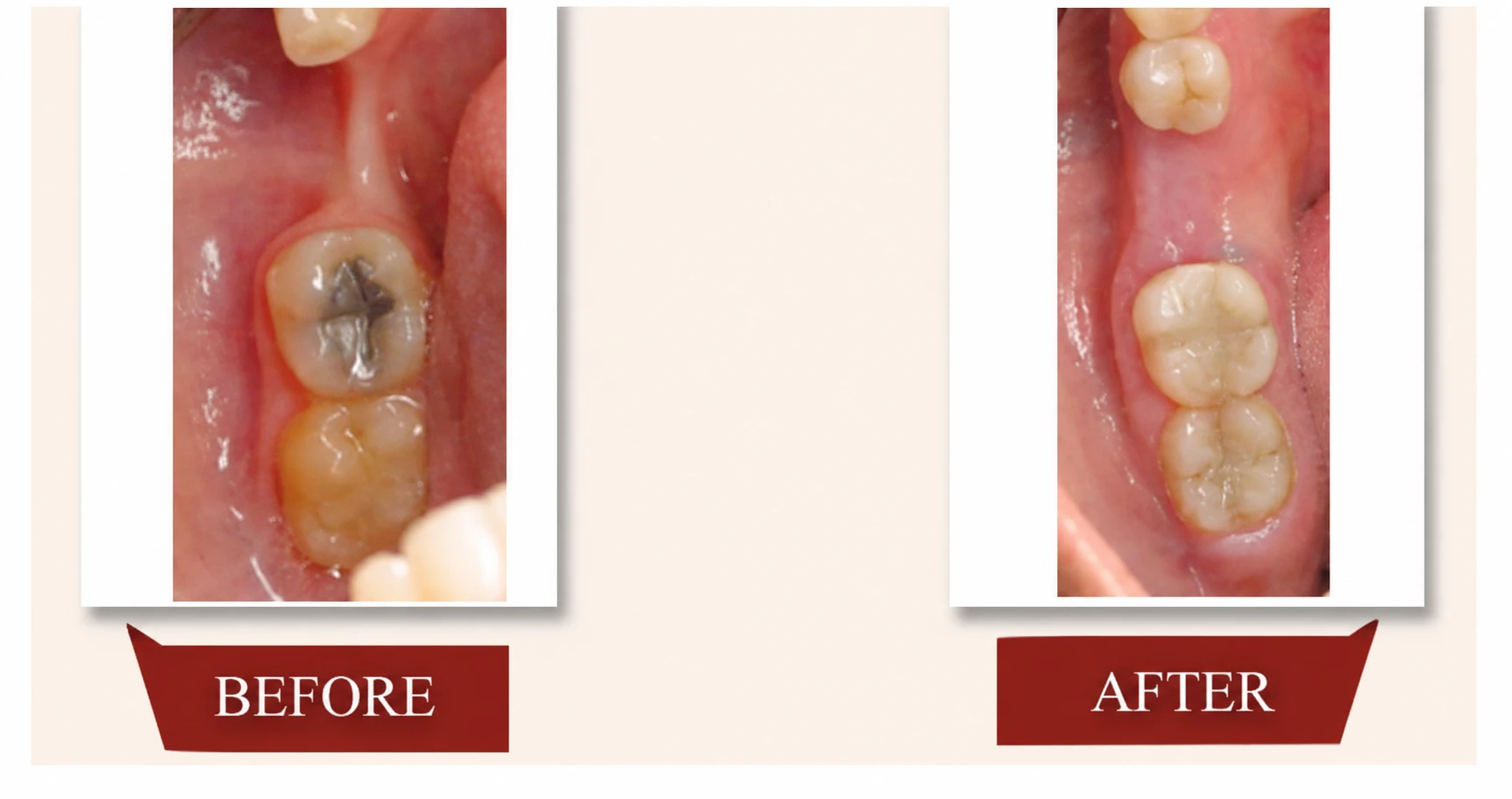 Before and after bone grafting result showing rebuilt jawbone support for future dental implant planning