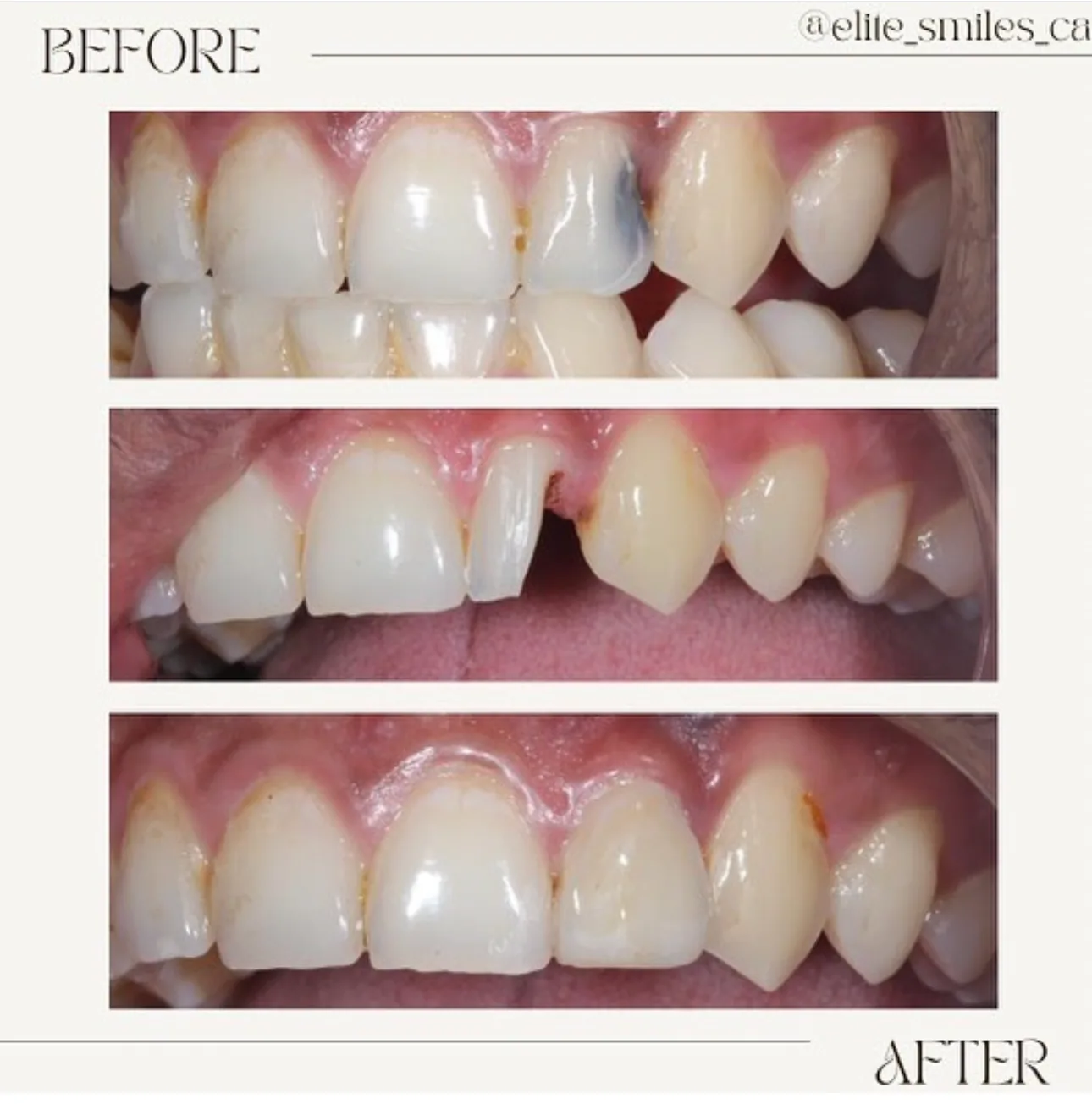 Before and after tooth-colored composite dental filling result