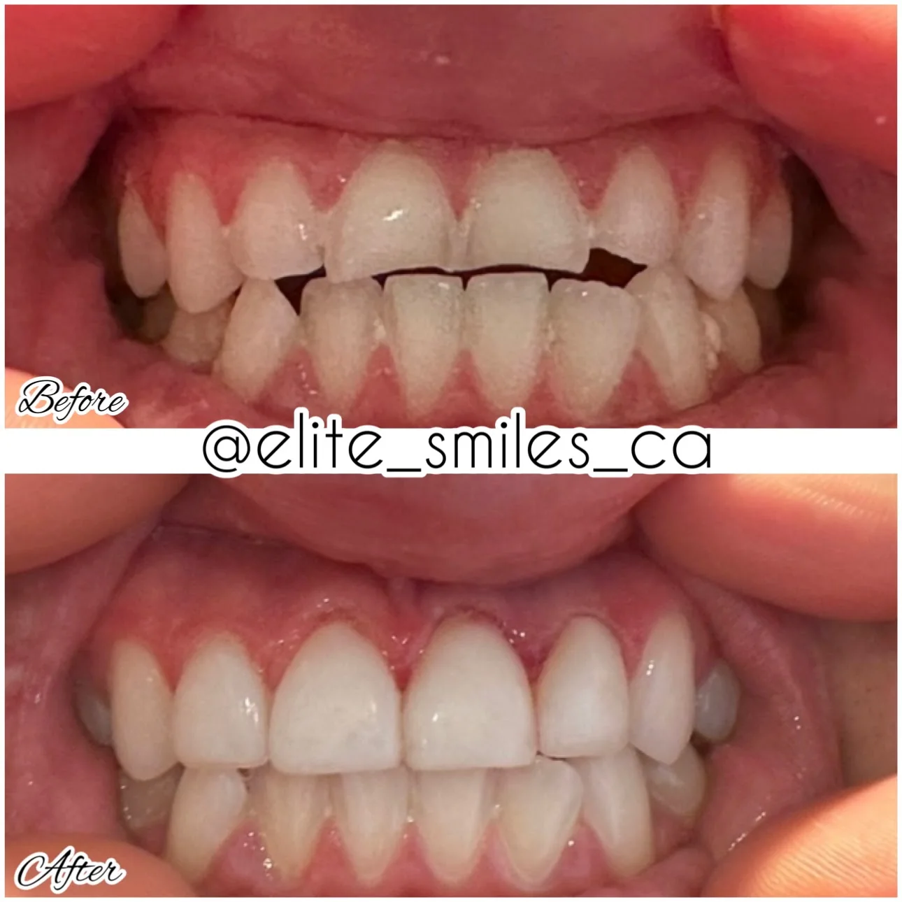 Before and after composite veneers smile transformation in La Jolla and Chula Vista