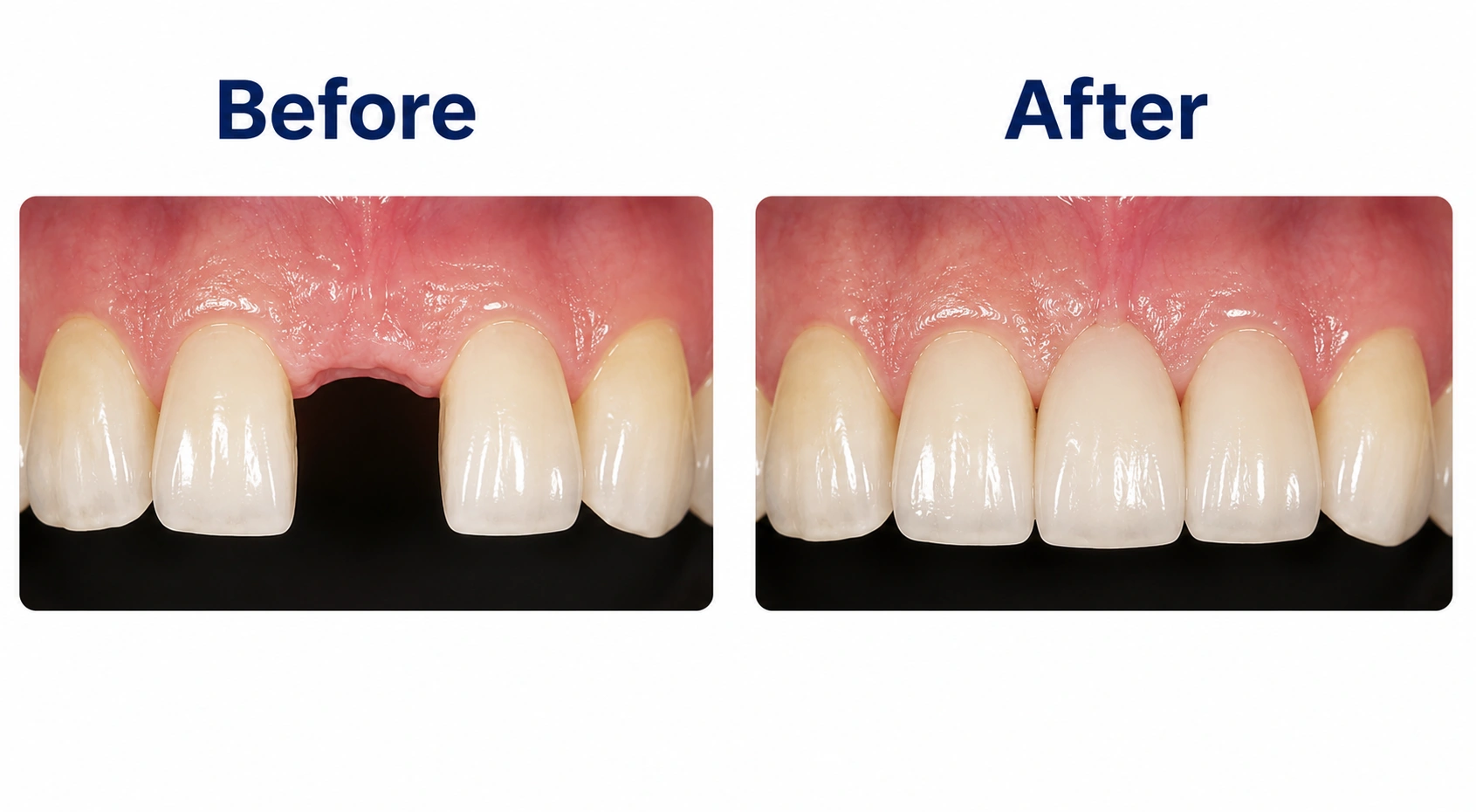 Before and after dental bridge replacing a missing front tooth