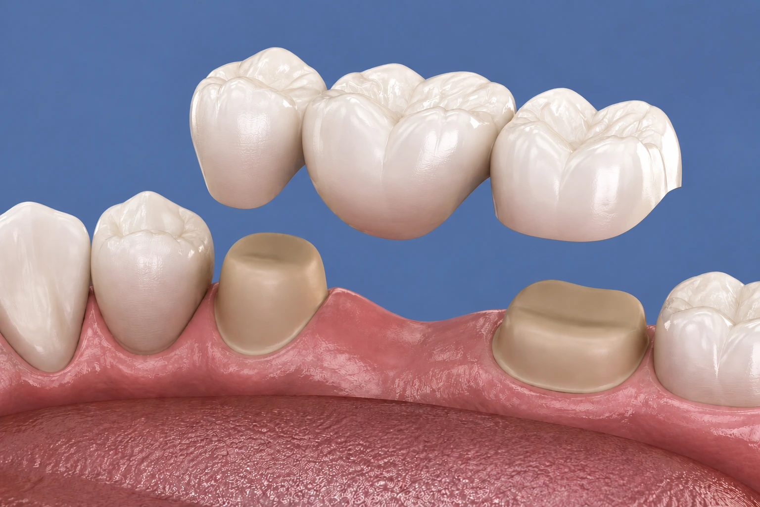 Dental bridges at Elite Smiles of La Jolla and Elite Dental Care in Chula Vista