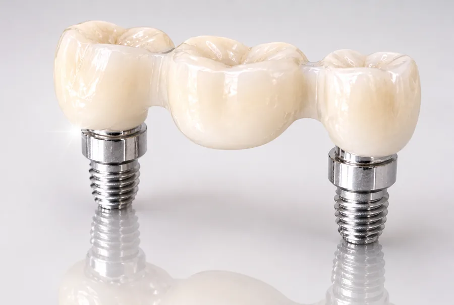 Dental bridges on implants at Elite Smiles of La Jolla and Elite Dental Care in Chula Vista