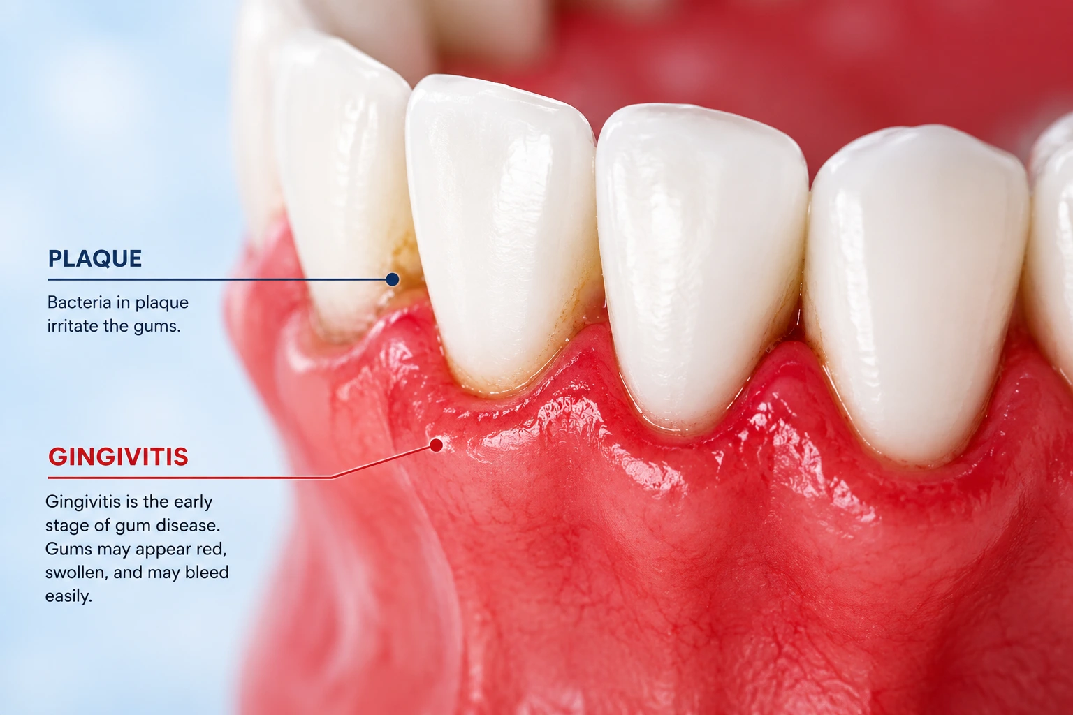 Gingivitis treatment for bleeding gums at Elite Smiles of La Jolla and Elite Dental Care in Chula Vista