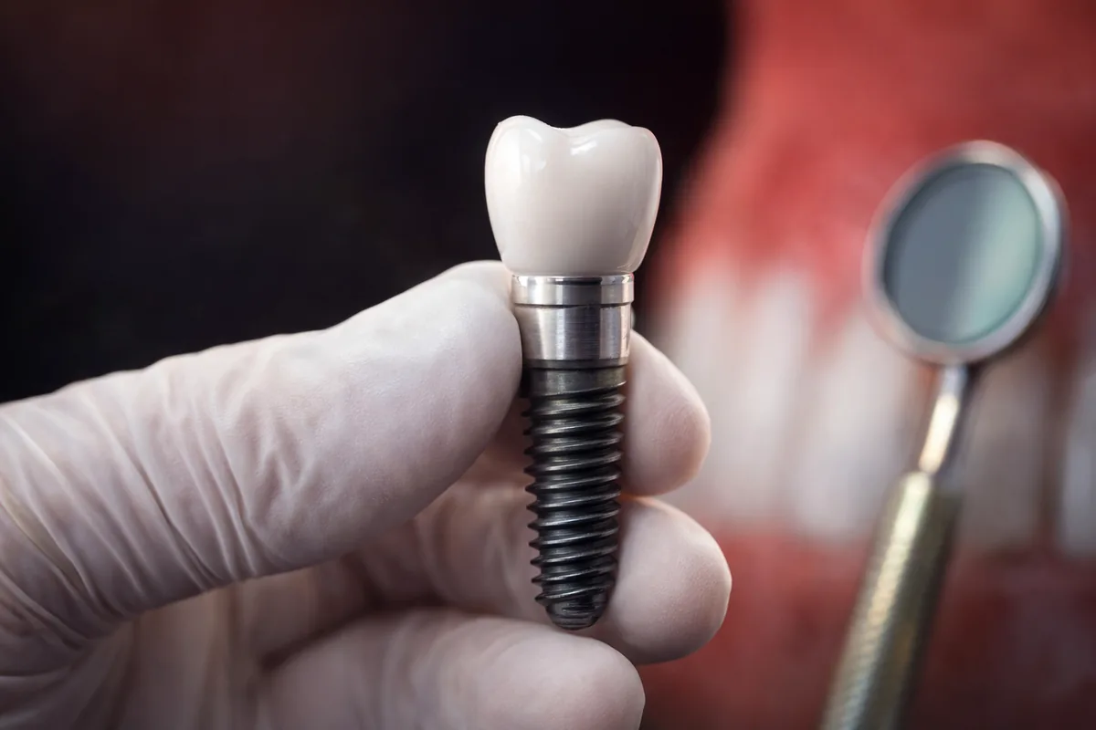 Dental Implants at Elite Smiles of La Jolla