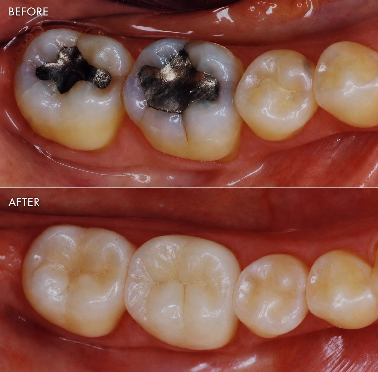 Before and after tooth-colored inlay and onlay restorations replacing old metal fillings