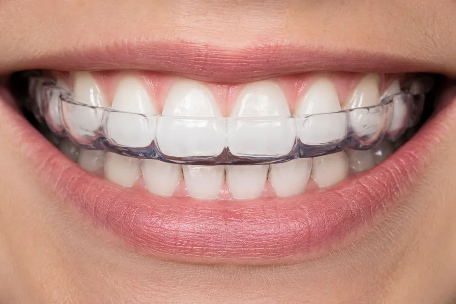 Custom night guard at Elite Smiles of La Jolla and Elite Dental Care in Chula Vista