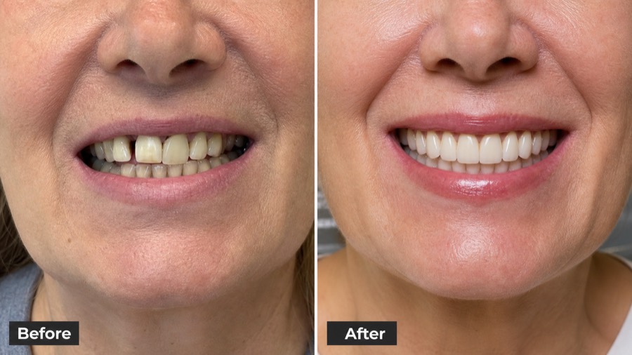 Before and after example of an implant-supported overdenture smile transformation