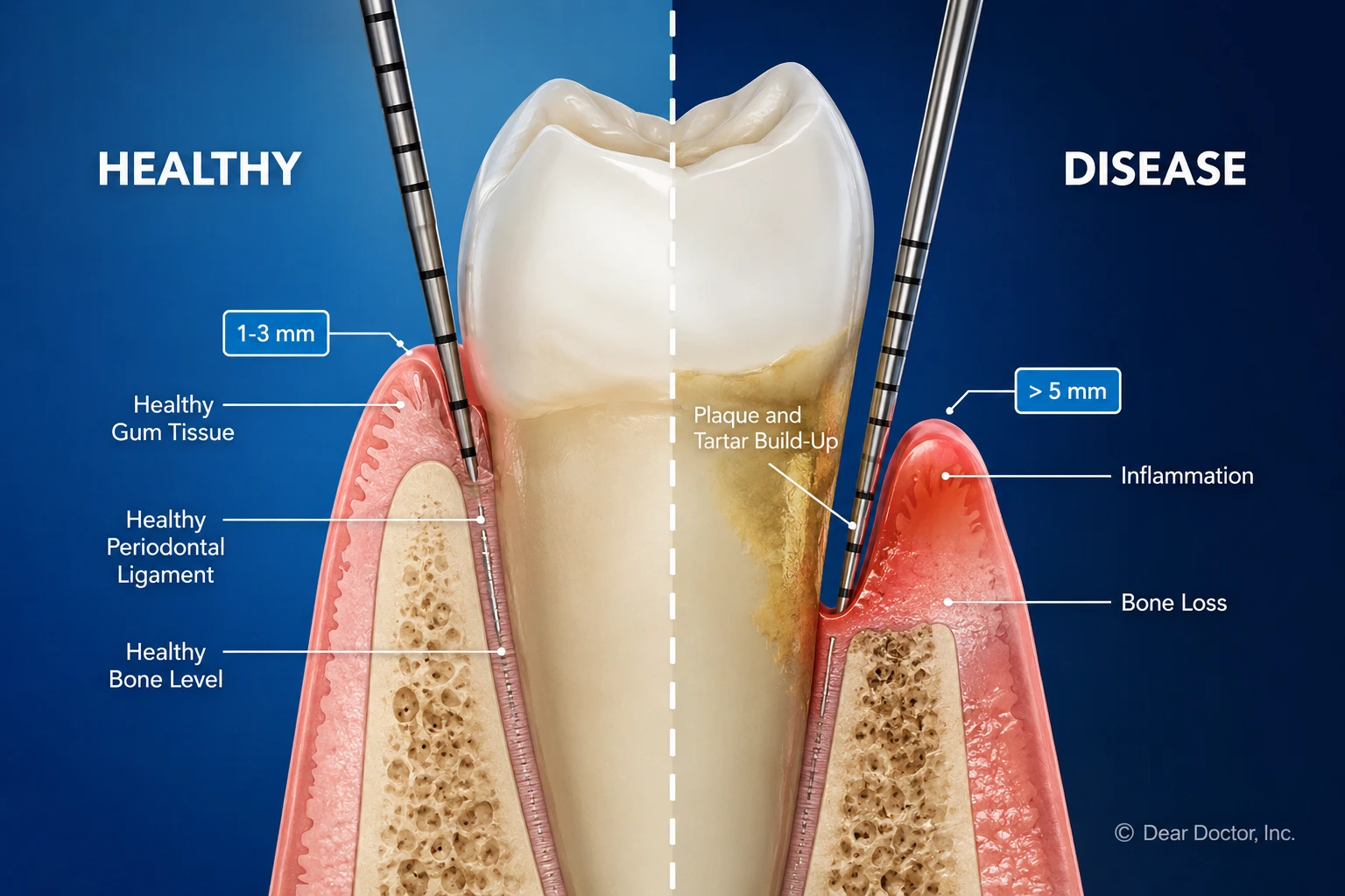 Periodontal maintenance cleaning at Elite Smiles of La Jolla and Elite Dental Care in Chula Vista