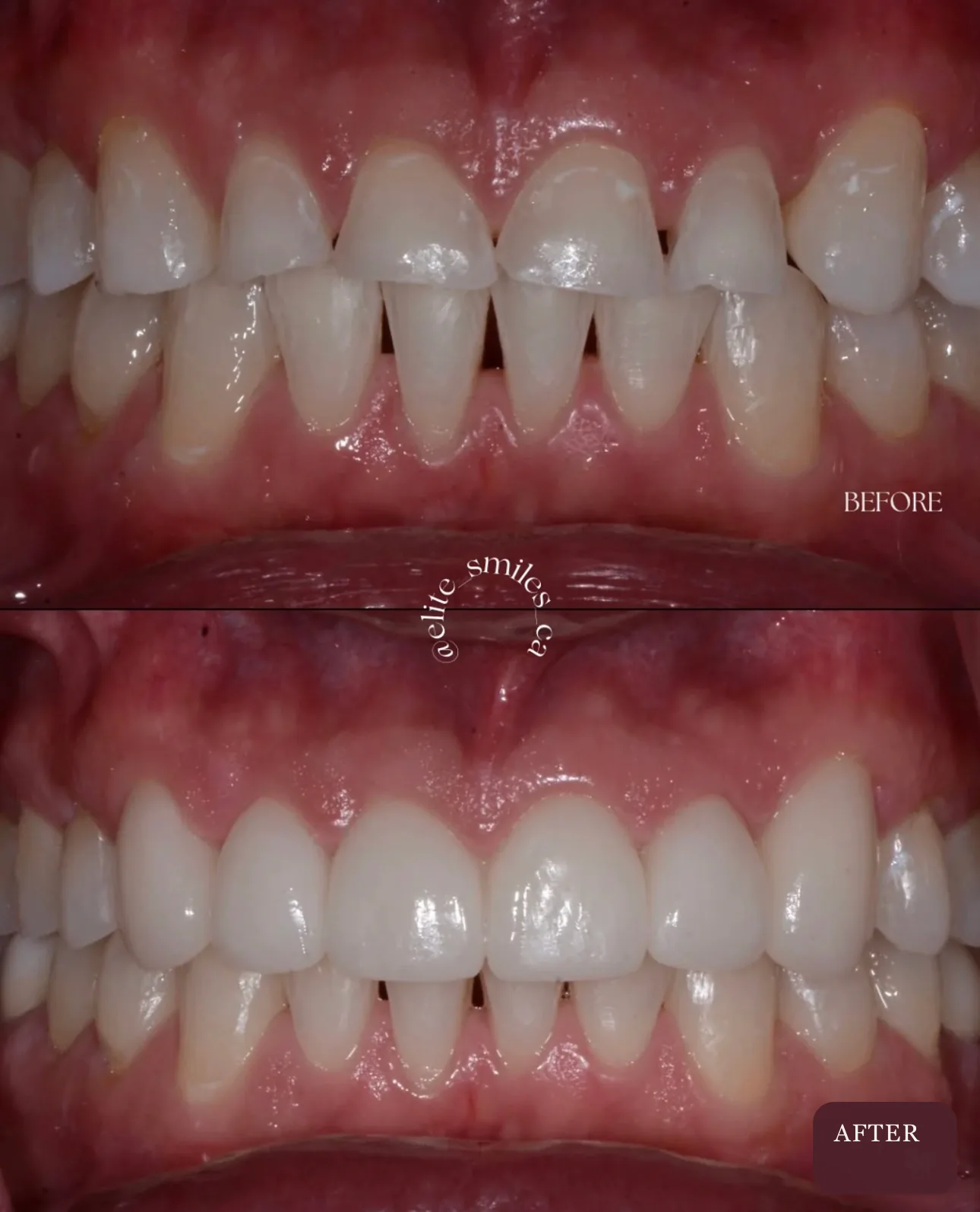 Patient smile enhanced with porcelain veneers in La Jolla and Chula Vista
